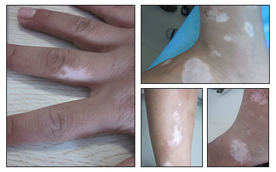 白癜风的图片和症状