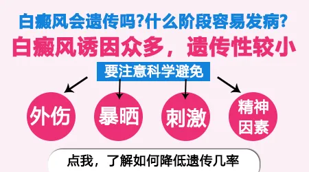 新生儿怎么判断有没有遗传白癜风