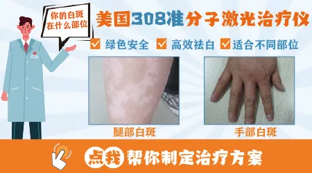 白癜风做308准分子光和308激光效果差多少