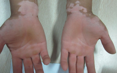 手心白癜风属于什么类型