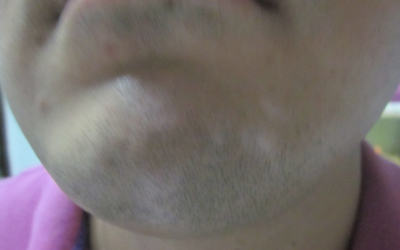 胡子刮伤形成一块白斑怎么回事
