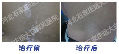 石家庄激光治疗白癜风的效果图