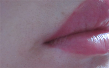 下嘴唇有白块图片 唇周白癜风怎么治