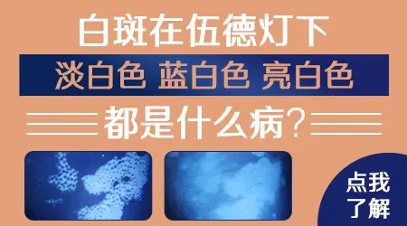 伍德灯下检查显示亮白色是什么