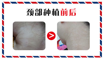 白癜风是不是一辈子也治不好