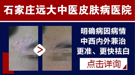 石家庄中西医结合治白癜风哪个医院好