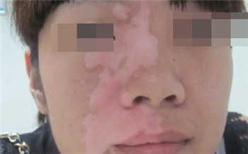 脸上有白斑是白癜风吗