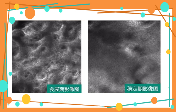 6.25世界白癜风日—“拒绝歧视,共抗白斑”普查援助活动