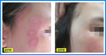 白癜风长在脸上怎么治