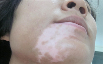 下巴有一块白斑怎么办 怎么判断白斑是否是白癜风