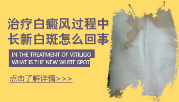 白癜风一边好一边长新的怎么办