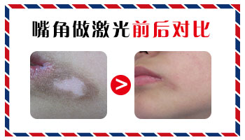 白癜风吃药治疗不见好转怎么回事