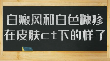 怎么区别白斑是白癜风还是白色糠疹