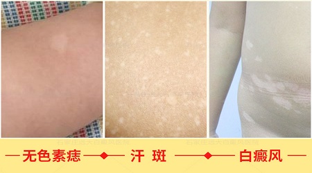 儿童白斑有什么特征 白斑是白癜风吗