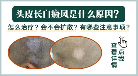 头皮一块一块的白