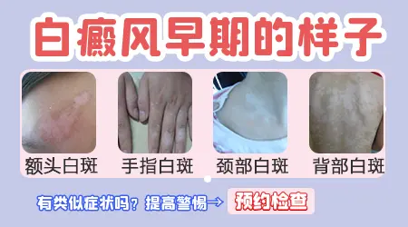 白癜风早期长什么样