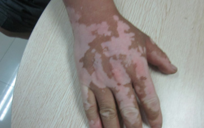 手指处皮肤变白是不是白癜风