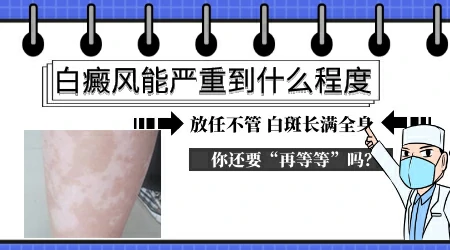 白癜风在孕期越来越严重怎么办