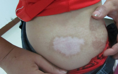 腹部的白斑有变大的趋势怎么办