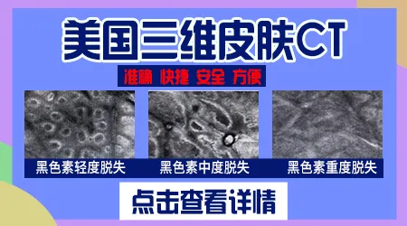 伍德灯能检测出白斑的黑色素脱失程度吗