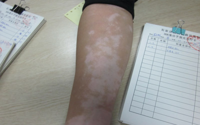 手臂上白点图片 白点是什么怎么治