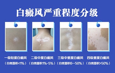 白癜风变严重了是什么样子