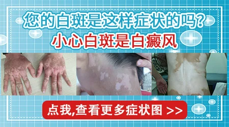 鼻子白斑最初期的样子