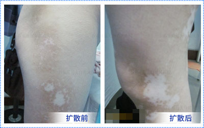 中药泡酒治白癜风的偏方有什么