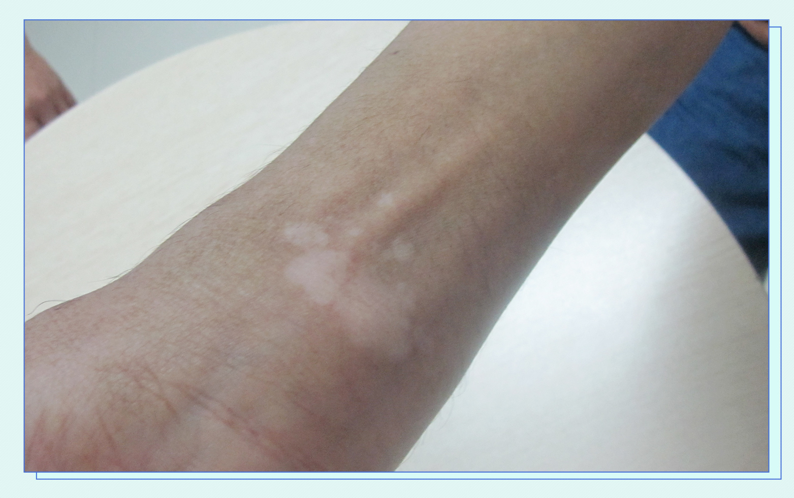 白癜风有什么症状 痒的话就不是白癜风吗