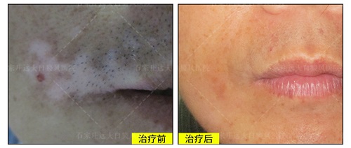 嘴四周白癜风需要用308准分子激光治疗吗