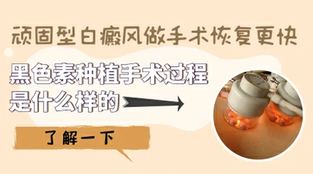 白癜风种植手术费用是按面积算的吗