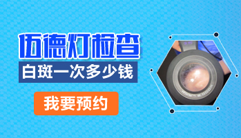 伍德氏灯检查白斑一次多少钱