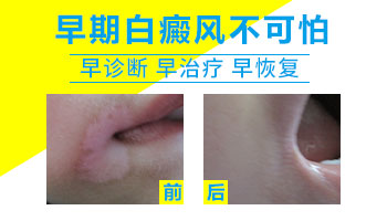 男性生殖器白癜风可以用光疗仪吗