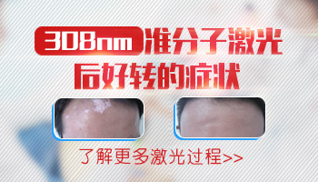 保定白癜风医院治疗费用