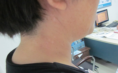 对于皮肤上隐隐约约的小白点你还敢忽视吗