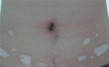 女性皮肤上白白的小点是怎么了