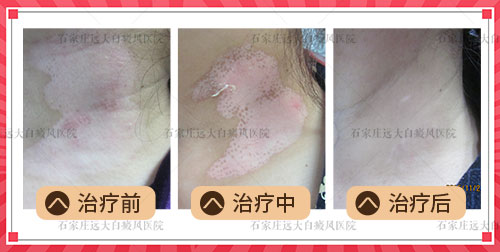 脖子上白癜风发现半个月了怎么治