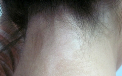 女性脖子长白斑两个月了怎么治疗好