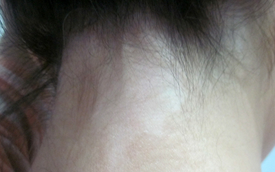 女性脖子长白斑两个月了怎么治疗好