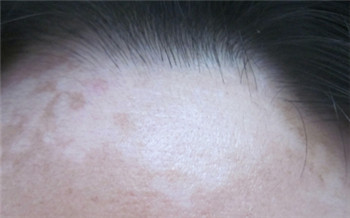 边界不清楚的白斑是白癜风吗