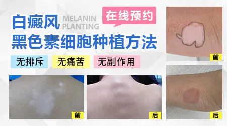 白癜风的黑色素种植手术疼不疼