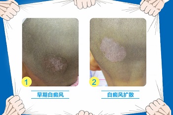 白癜风白斑的症状有哪些 白斑会不会扩散