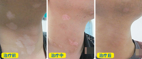 用补骨脂泡酒擦白癜风多久见效