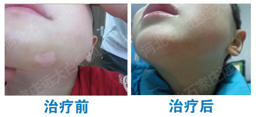 石家庄哪家医院能治好早期白癜风