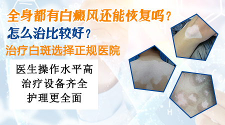 全身都有白癜风十来年了还治得好吗