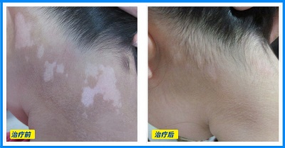 白癜风如何治 有什么新方法吗