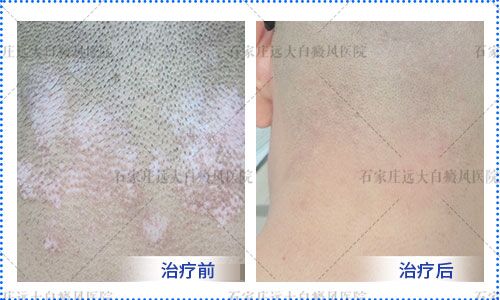 宝宝头皮上长了一个小白点