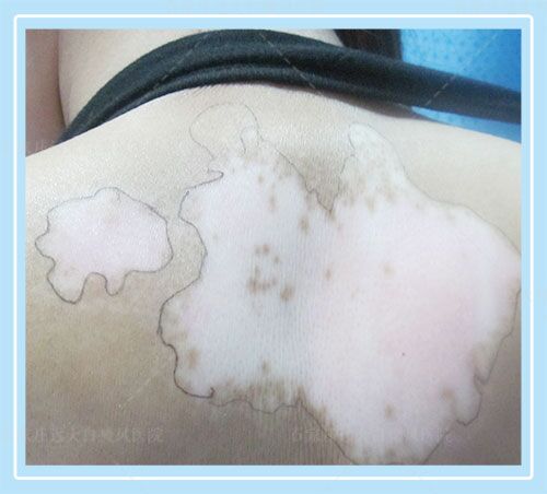 白癜风黑色素移植是按平方厘米算吗