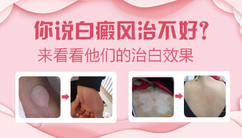 保定治疗白癜风的医院_保定白斑医院只看白癜风