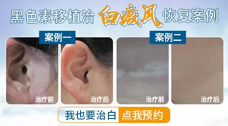 白癜风植皮手术效果图